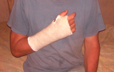 leider mein Arm in Gips!